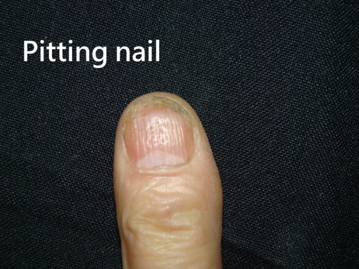 指甲乾癬－點狀凹陷（Pitting nail）