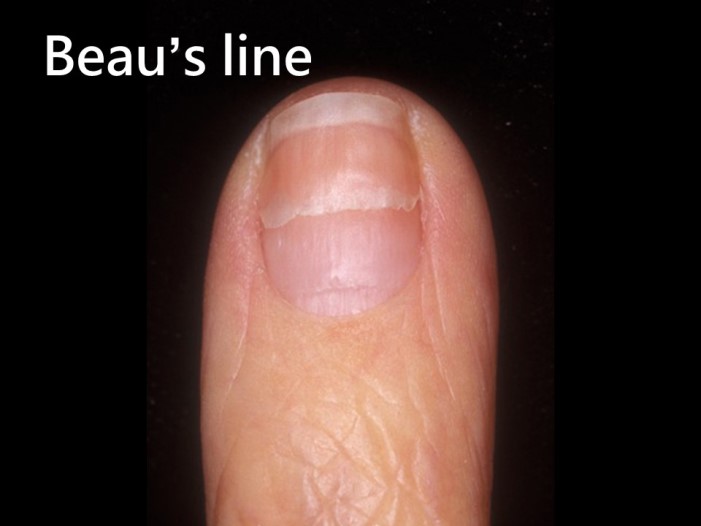 指甲乾癬－Beau’s line