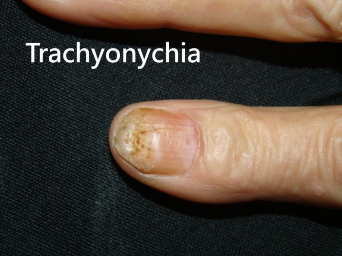 指甲乾癬－粗面指甲（Trachyonychia）