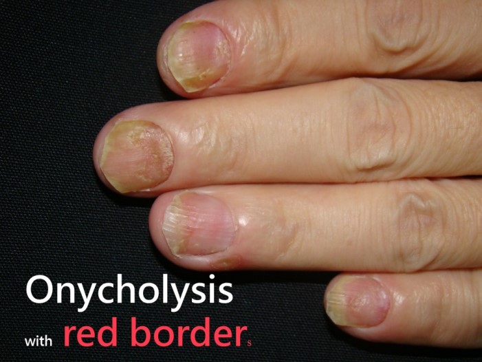 指甲乾癬－指甲分離（Onycholysis）
