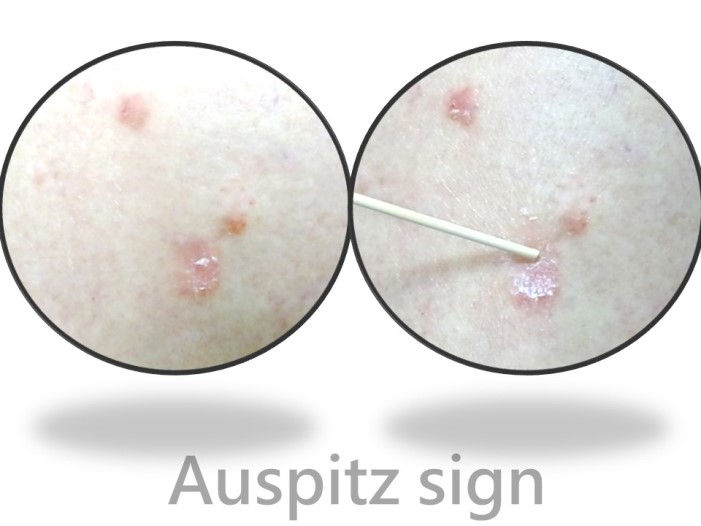 診斷乾癬－Auspitz sign