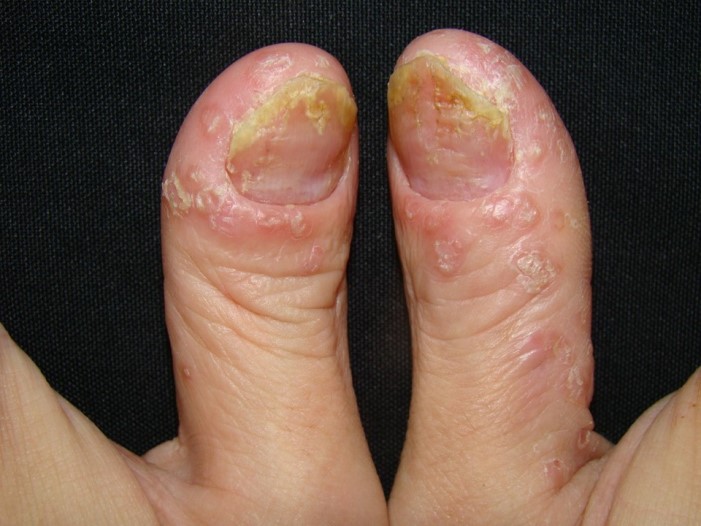 膿疱型乾癬（Pustular type）