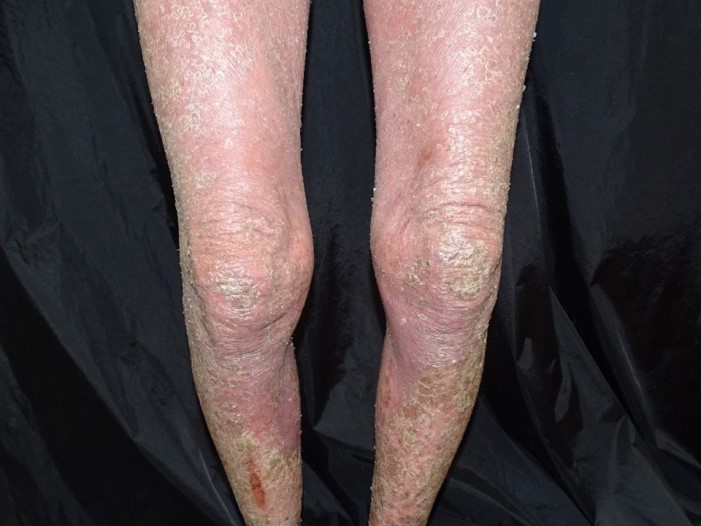 紅皮症乾癬（Erythrodermic psoriasis）
