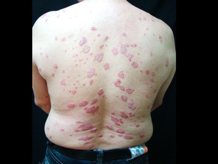 典型乾癬病灶 帶有白色麟狀皮屑的紅色板塊