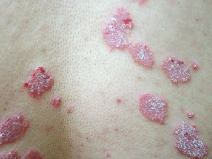 典型乾癬病灶 帶有白色麟狀皮屑的紅色板塊