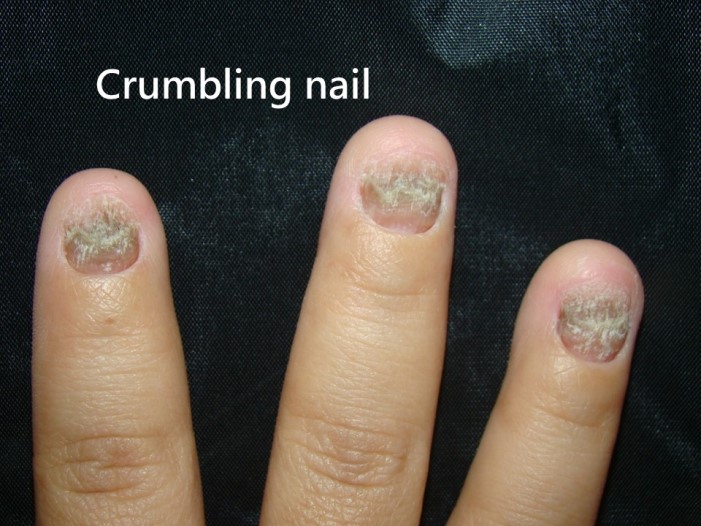 指甲乾癬－Crumbling nail