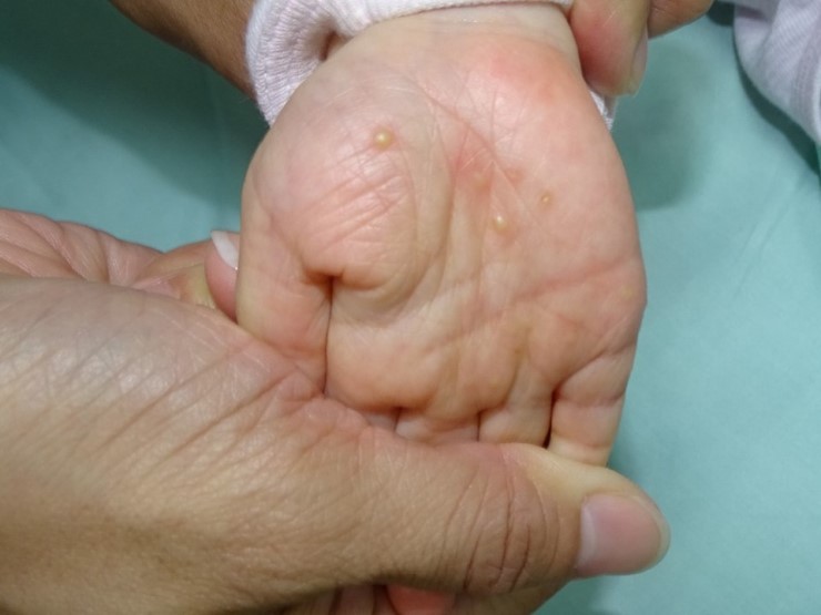 嬰幼兒疥瘡特色–照護線上, scabies - CareOnline