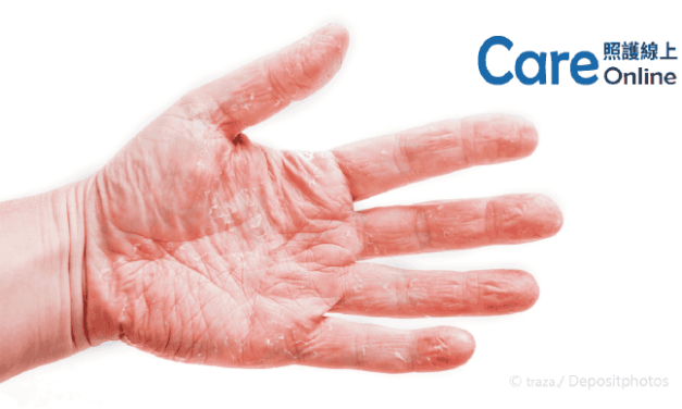 富貴手、汗皰疹，醫師教你解決手部濕疹！