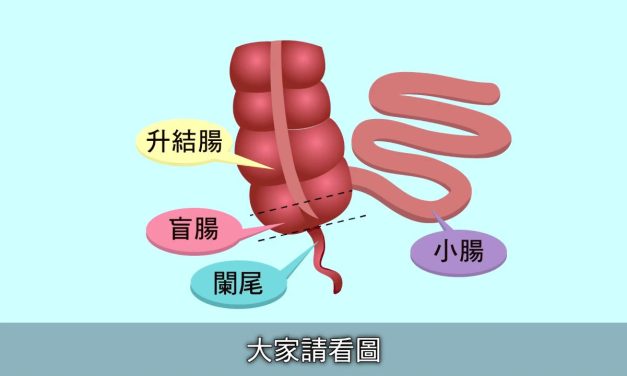 【醫師聊天室】急性闌尾炎發作該怎麼辦？