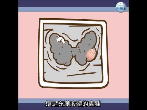 內分泌系統最常見的癌症 – 甲狀腺癌（動畫）