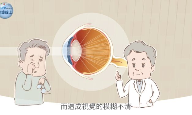 白內障手術選對人工水晶體，生活便利又安全