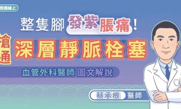 整隻腳發紫、脹痛！搶通深層靜脈栓塞，血管外科醫師圖文解說