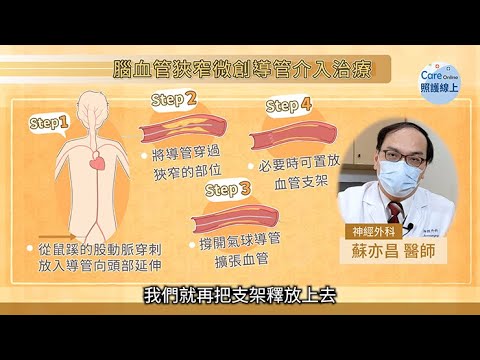打通腦血管狹窄，搶救腦中風