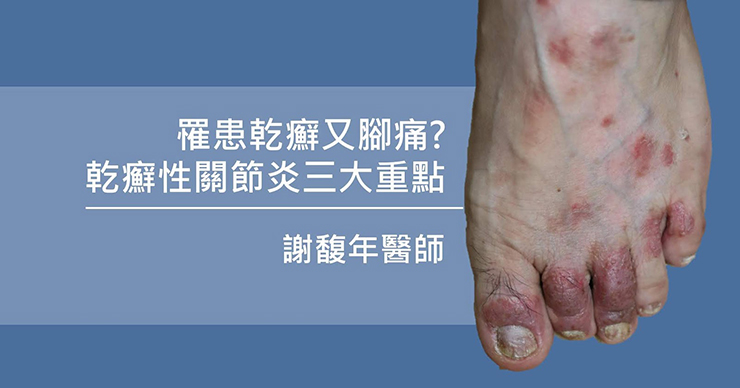 罹患乾癬又腳痛？乾癬性關節炎的三大重點