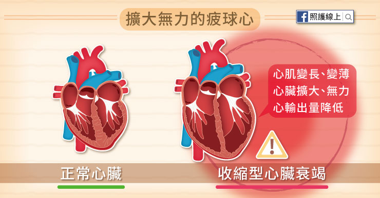 心肌變長、變薄，心臟擴大又無力，所以心臟衰竭又被稱作「疲球心」