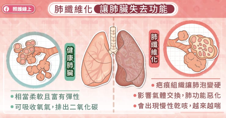 肺纖維化，讓肺臟失去功能