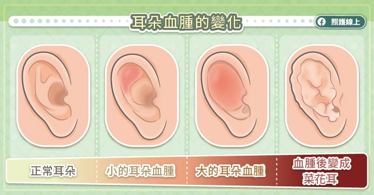 耳朵血腫的變化