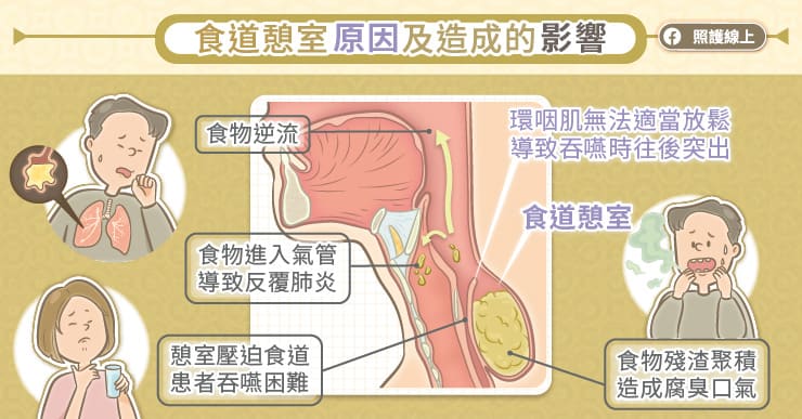 食道憩室原因及造成的影響