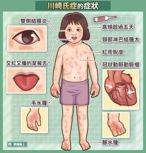 讓小孩高燒不斷、草莓舌、紅疹脫皮的「川崎式症」 | 照護線上-深受信賴的醫療媒體