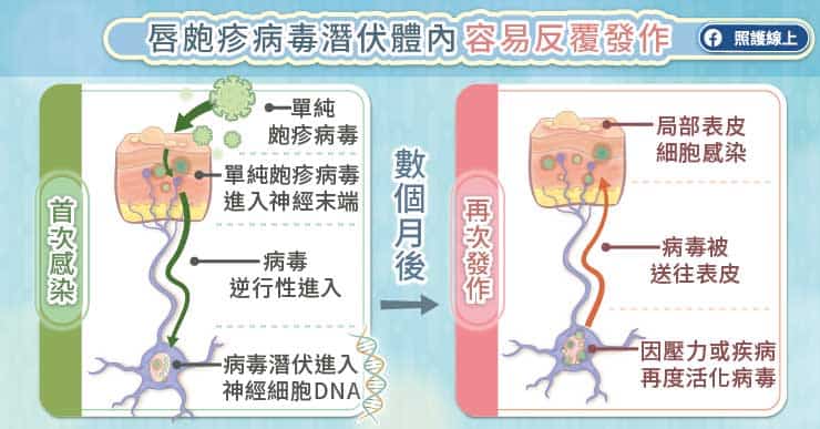 唇皰疹容易反覆發作