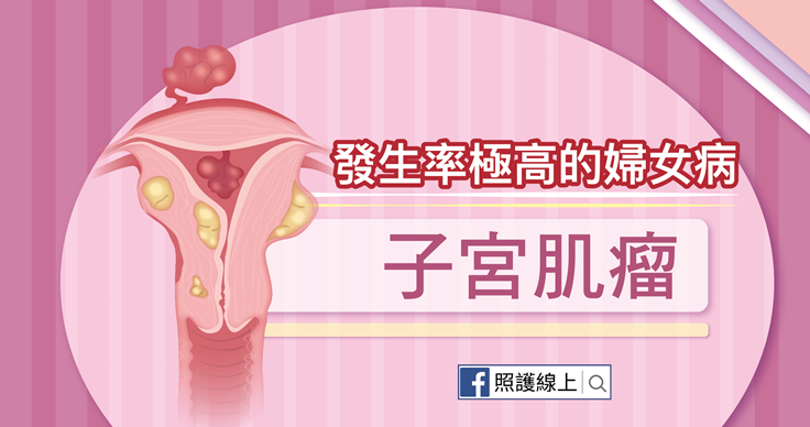 發生率極高的婦女病 – 子宮肌瘤（懶人包）
