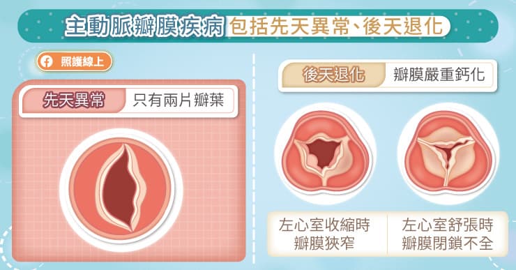 主動脈瓣膜狹窄包括先天異常、後天退化