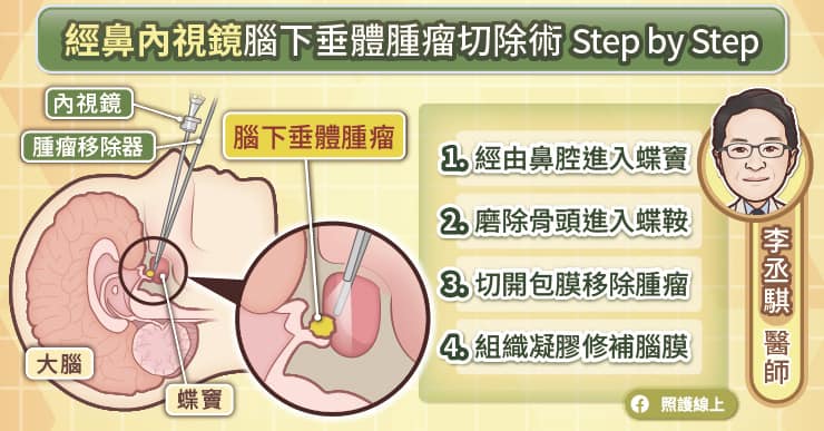 經鼻內視鏡腦下垂體腫瘤切除手術