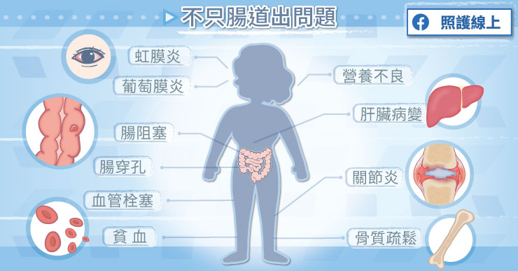 發炎性腸道疾病不只影響腸道，還可能出現腸道外表現