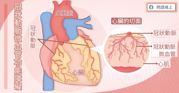 女性也會心臟病發，可能不會胸痛！冠狀動脈微血管功能障礙，警訊愛注意（懶人包）