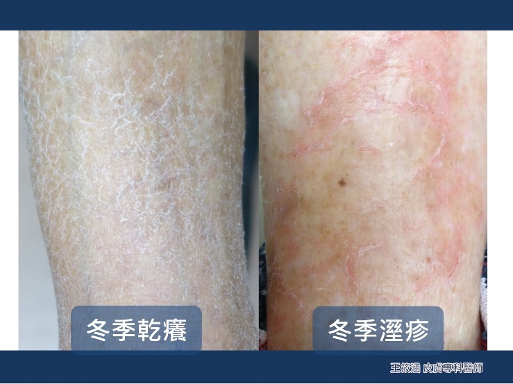 冬季乾癢、冬季溼疹，醫師教你解決乾燥性皮膚炎！
