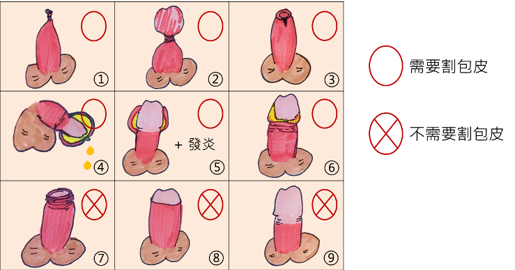 哪些狀況需要割包皮呢？