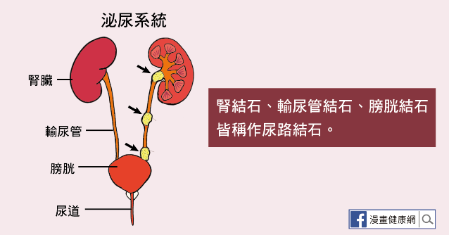 尿路結石包含腎結石、輸尿管結石、與膀胱結石