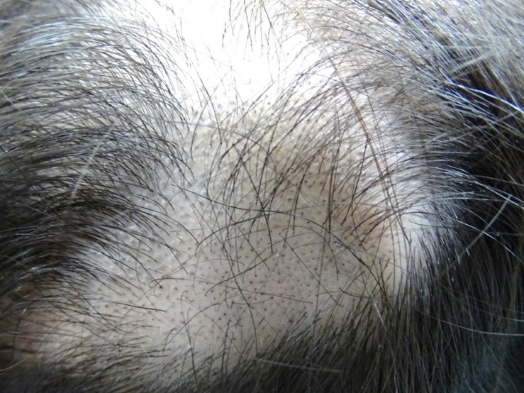 拔毛癖可以看到長短不一的斷髮，有些只剩頭皮上毛囊開口的黑點