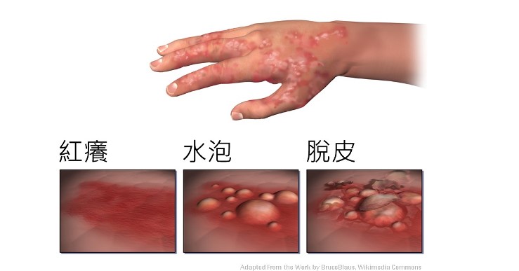 汗皰疹的表現：紅癢、水泡、脫皮