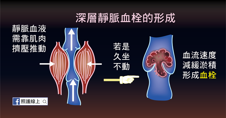 深層靜脈血栓的形成