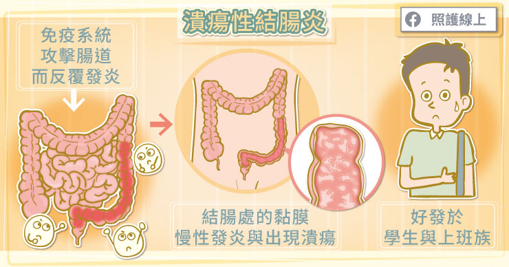 潰瘍性結腸炎