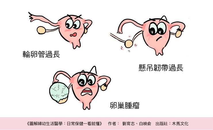 那些人容易出現卵巢扭轉？