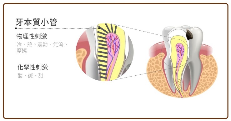 牙本質小管的暴露造成牙齒敏感