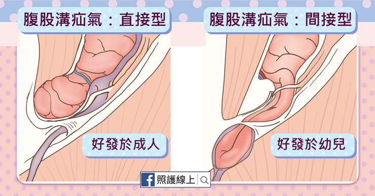 腹股溝疝氣有兩種類型：直接型與間接型腹股溝疝氣-照護線上