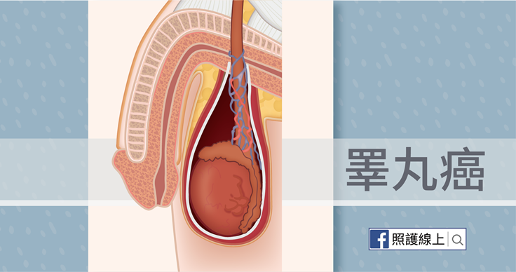 不會痛但硬硬的 – 睪丸癌（懶人包）