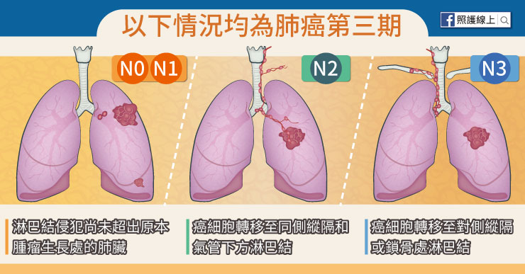 肺癌第三期