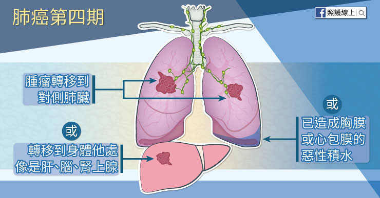 肺癌第四期