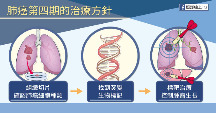 肺癌第四期治療方針