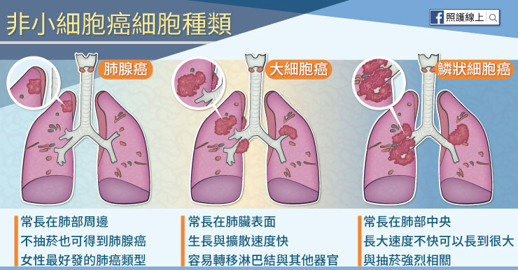 非小細胞癌細胞種類