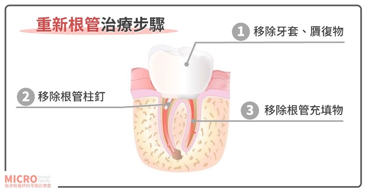 為什麼要重新根管治療？有什麼差別嗎？