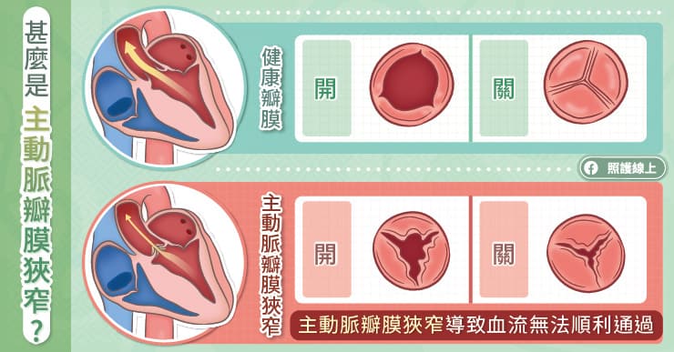 主動脈瓣膜狹窄
