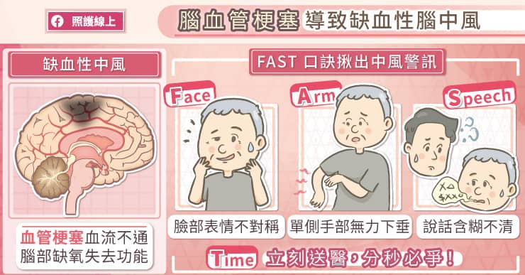 腦血管梗塞導致缺血性腦中風