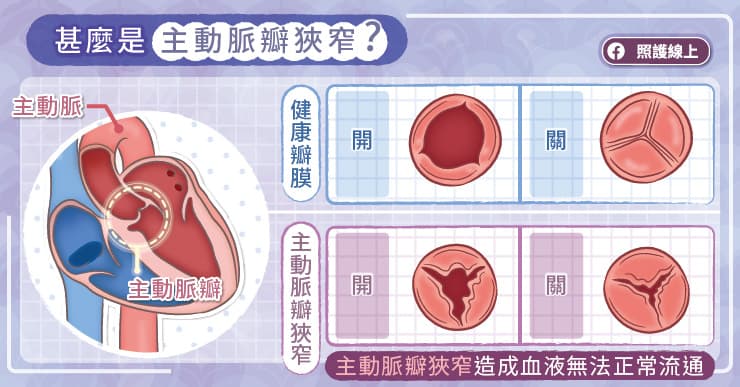 什麼是主動脈瓣膜狹窄？