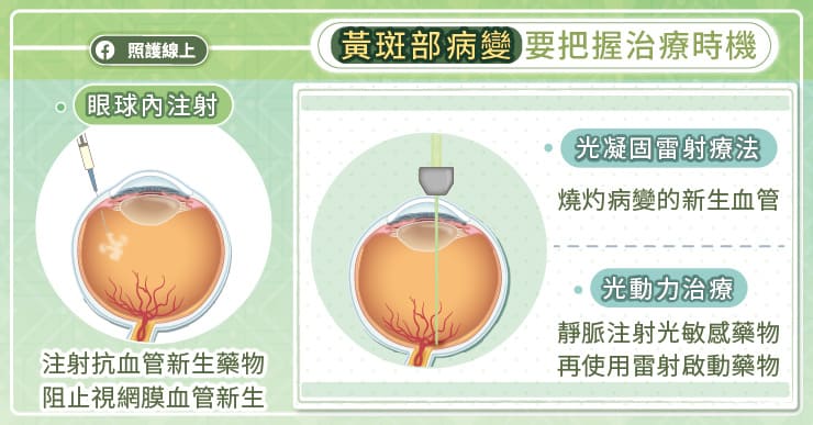 黃斑部病變要把握治療時機