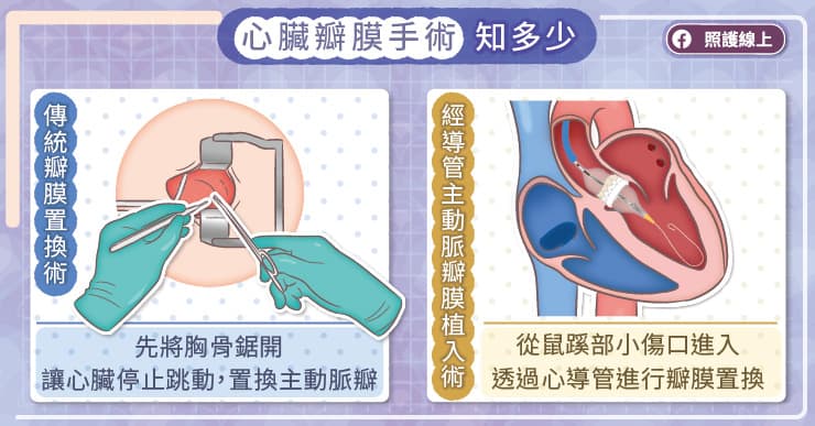 心臟瓣膜置換手術知多少